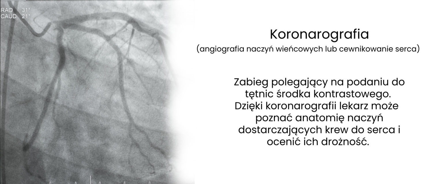 Koronarografia Na Czym Polega Ile Trwa Czy Jest Bezpieczna Doktor Stent 0957